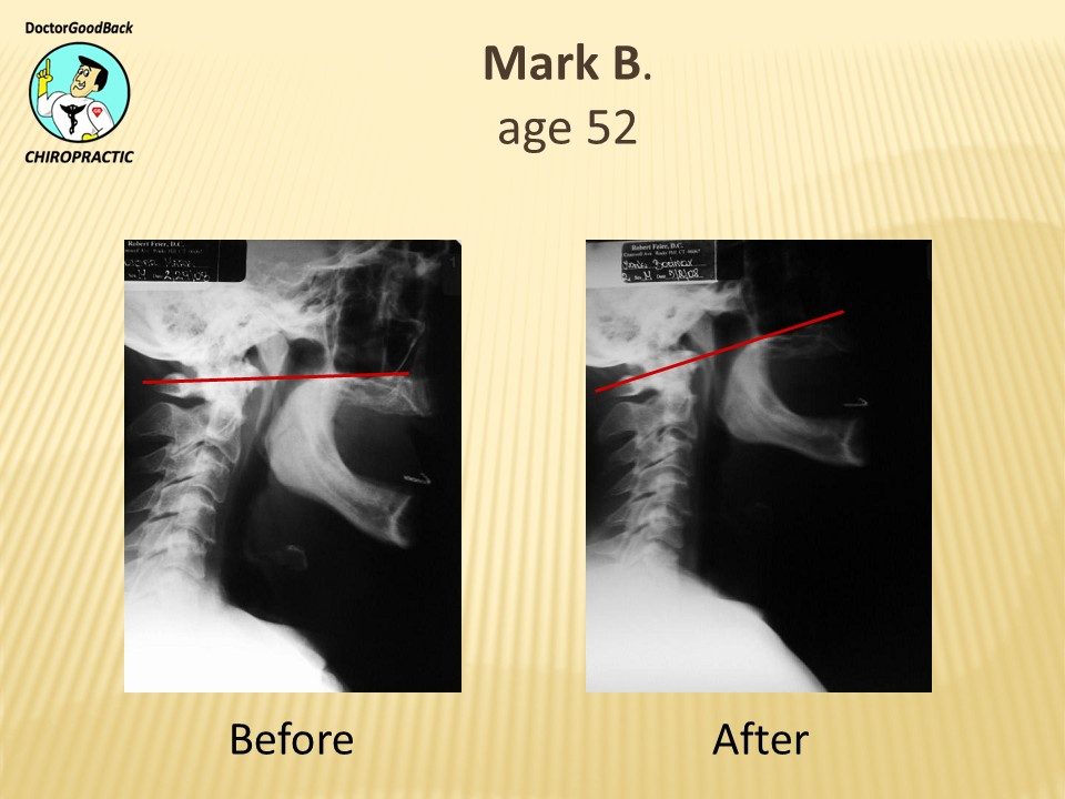 Before and after case 6