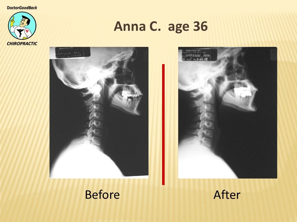 Before and after case 11