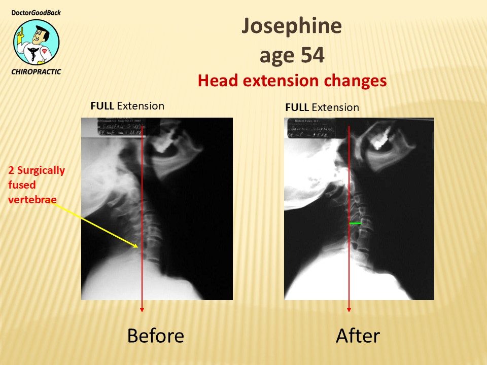 Before and after case 17
