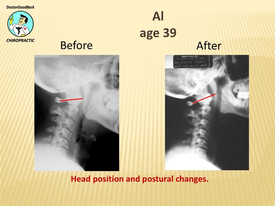 Before and after case 20
