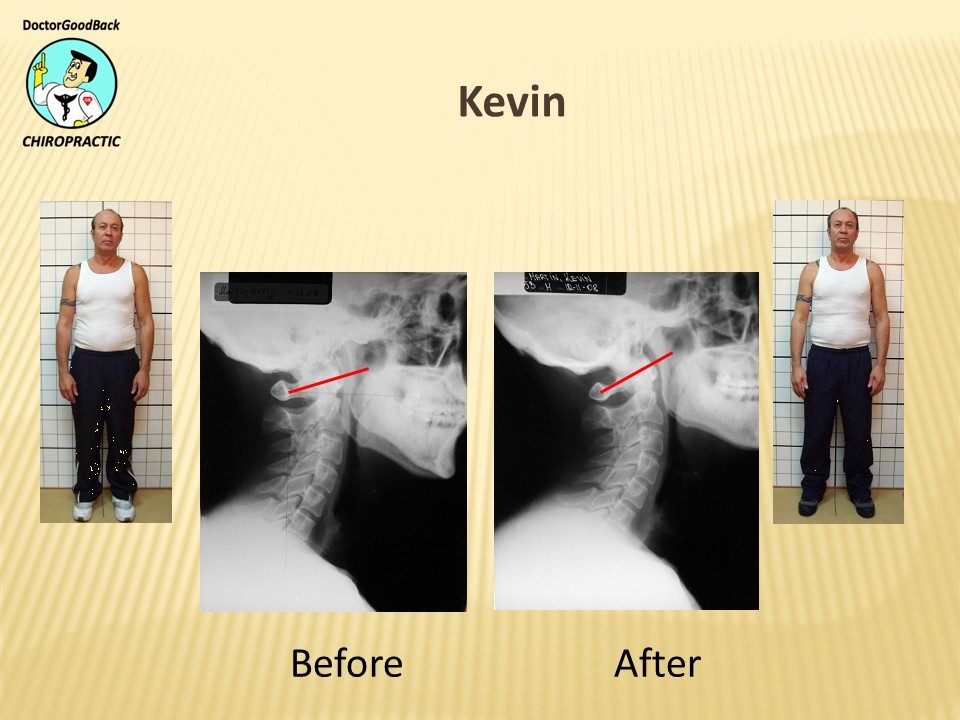 Before and after case 21