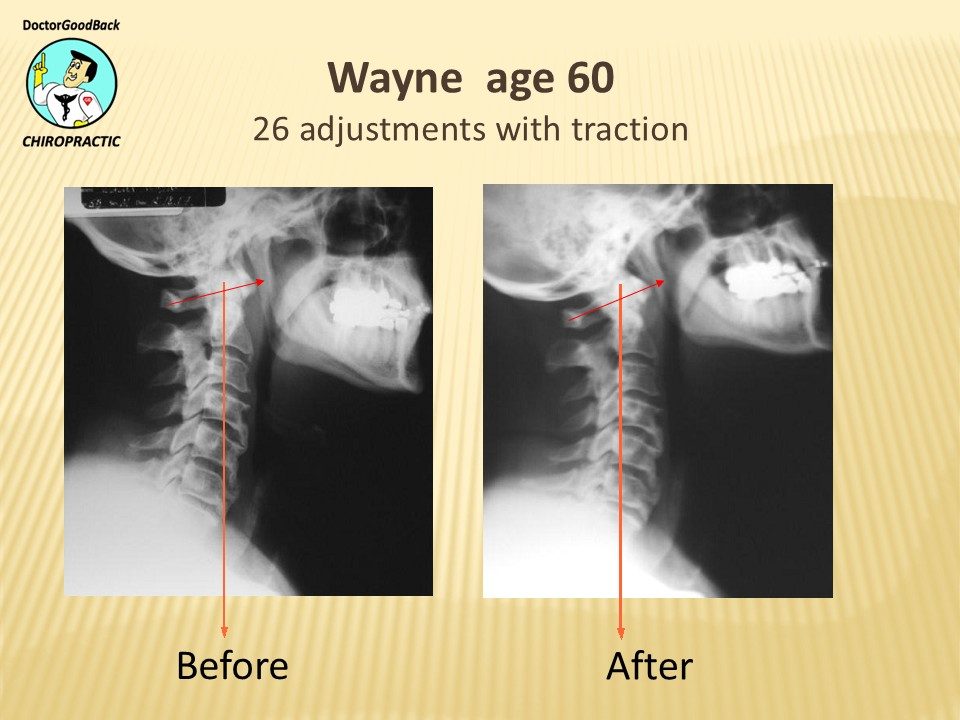 Before and after case 23
