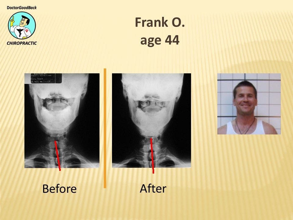 Before and after case 26