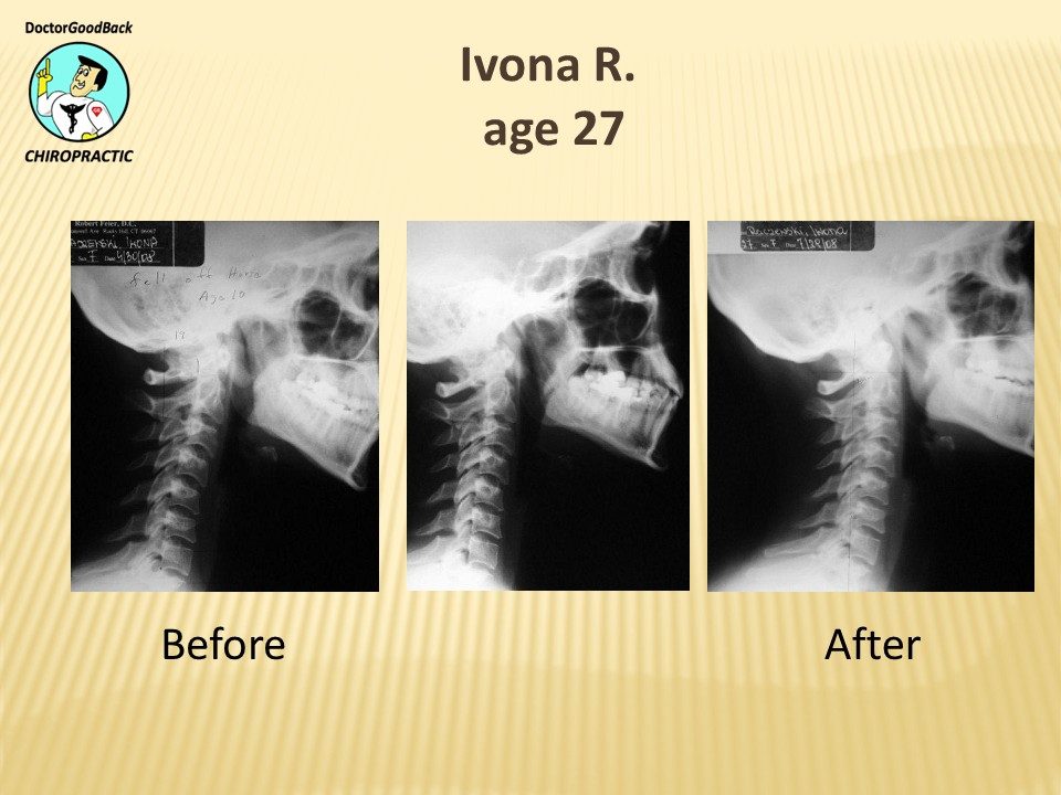 Before and after case 29