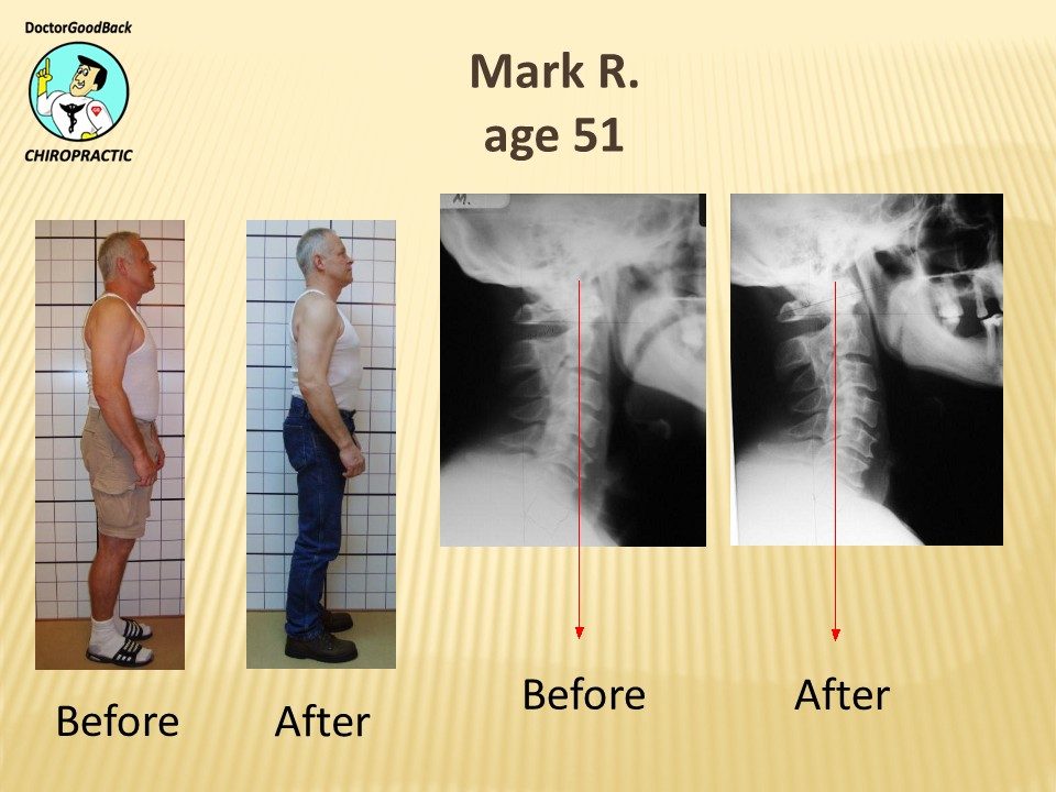 Before and after case 30