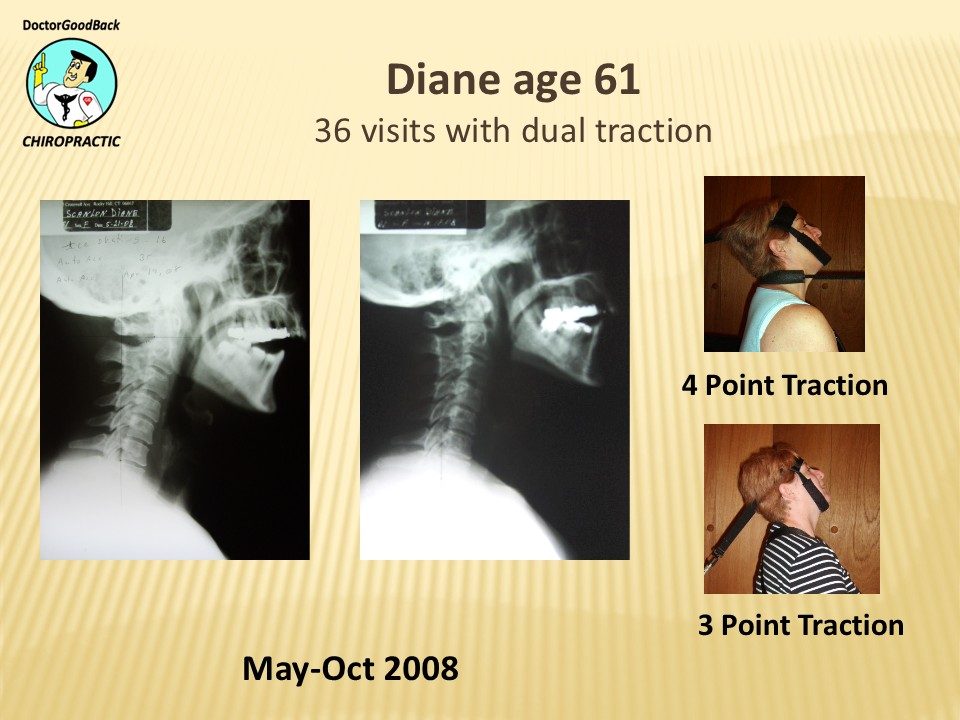 Before and after case 32