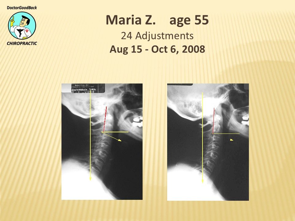 Before and after case 34