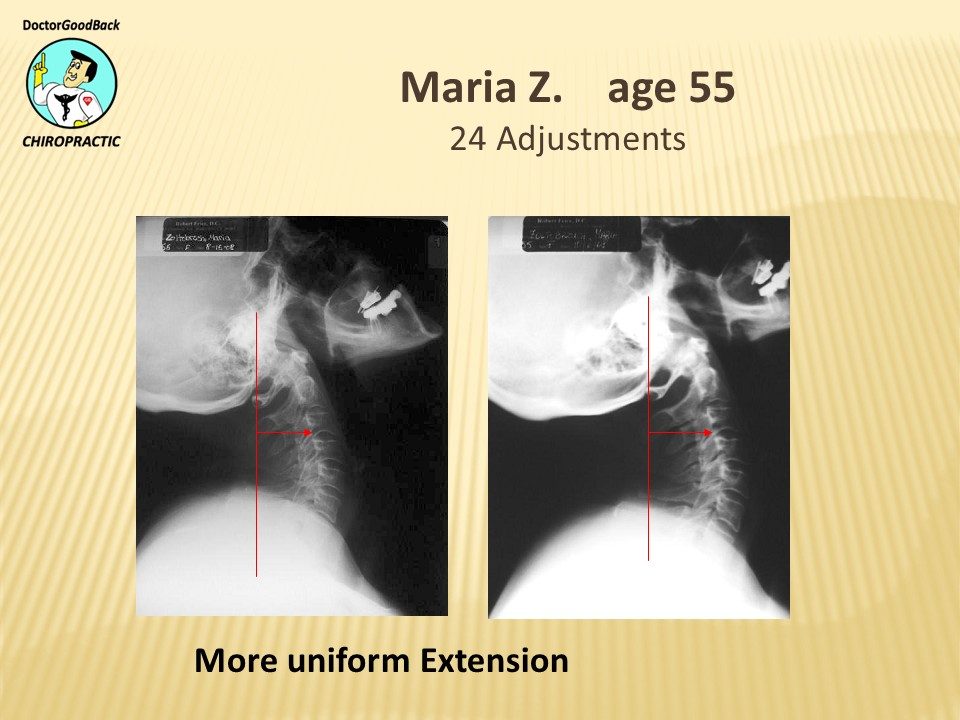 Before and after case 35