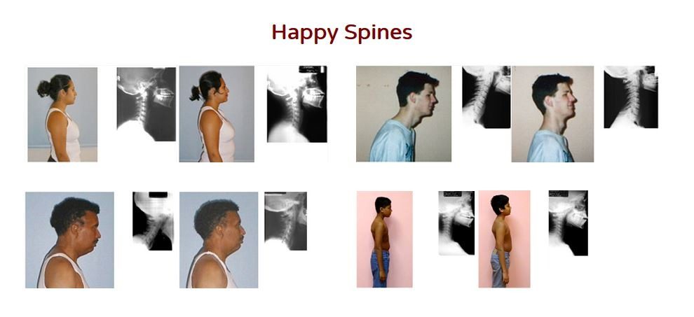 Happy Spines: before and after posture photos and X-rays of four patients