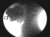 Video X-ray of a neck in motion